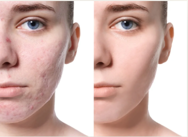 Before and after acne scar treatment results showing clearer skin