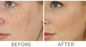 Before and after comparison showing reduction of dark spots and pigmentation on a woman's cheek