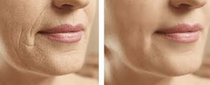 Before and after comparison of facial skin showing reduced wrinkles and smoother skin texture around the mouth and cheeks