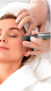 Microneedling treatment being performed at Skinneon Beauty and Laser Clinic Bristol